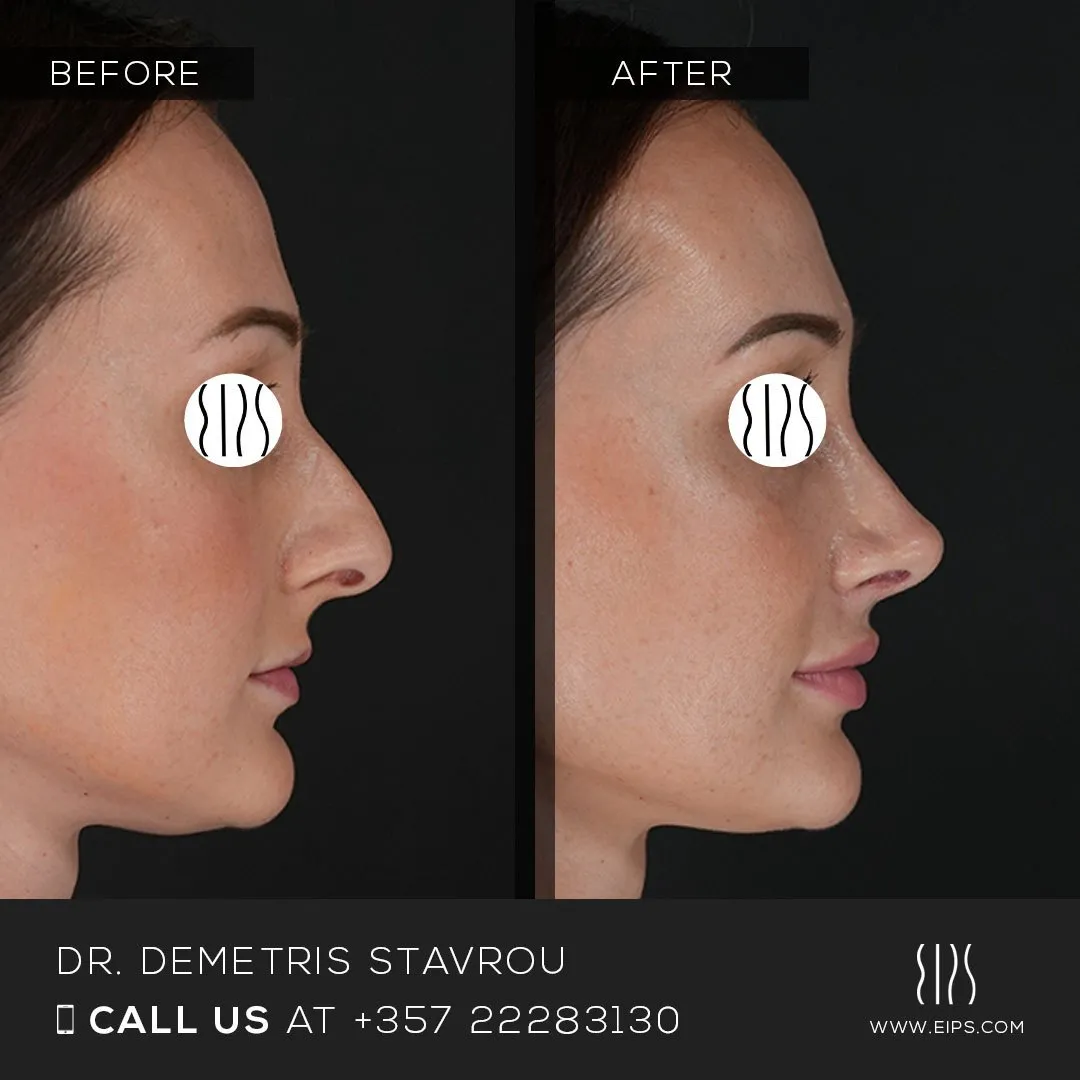 Rhinoplasty before and after