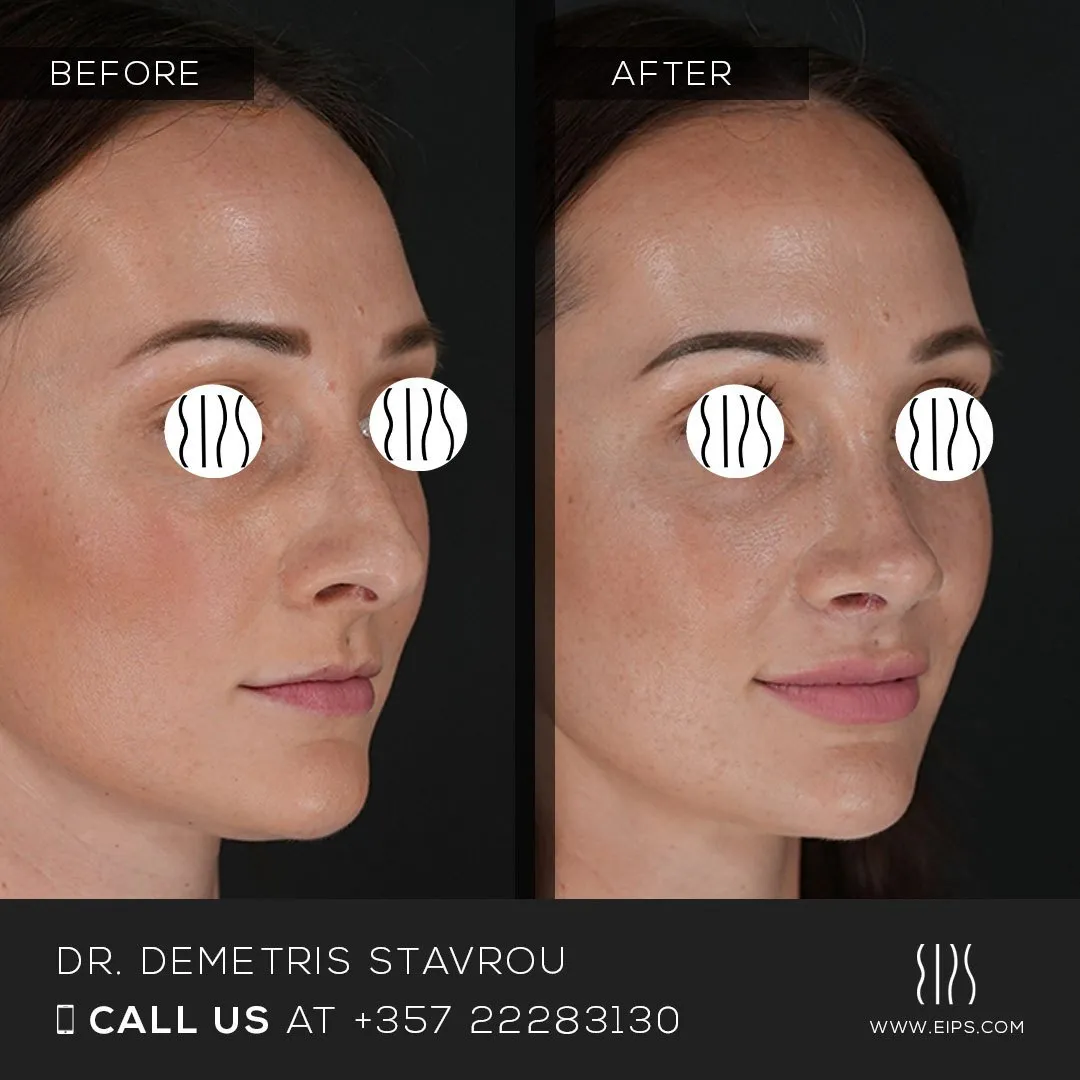 Rhinoplasty before and after