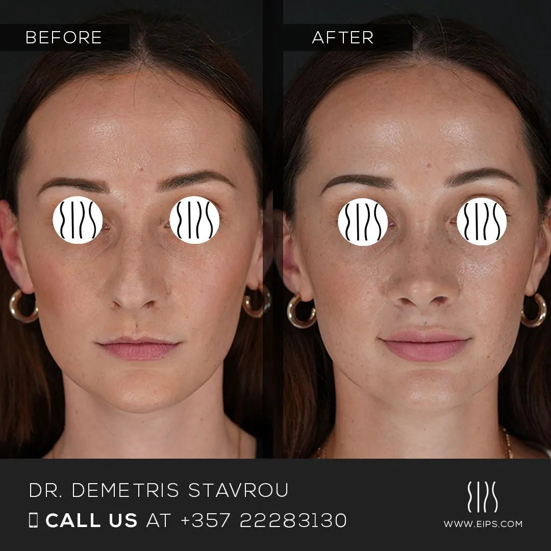 Rhinoplasty before and after