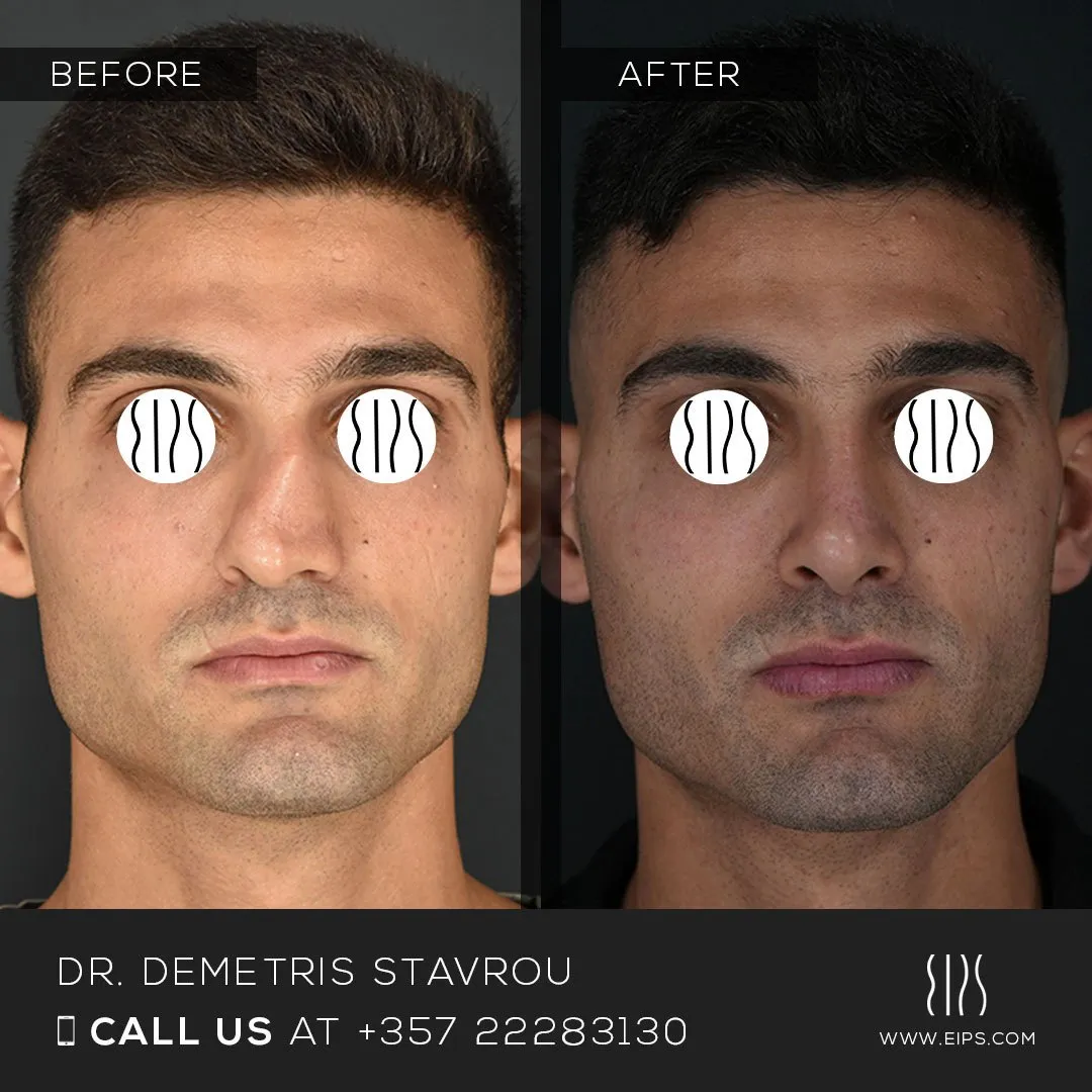 Rhinoplasty before and after