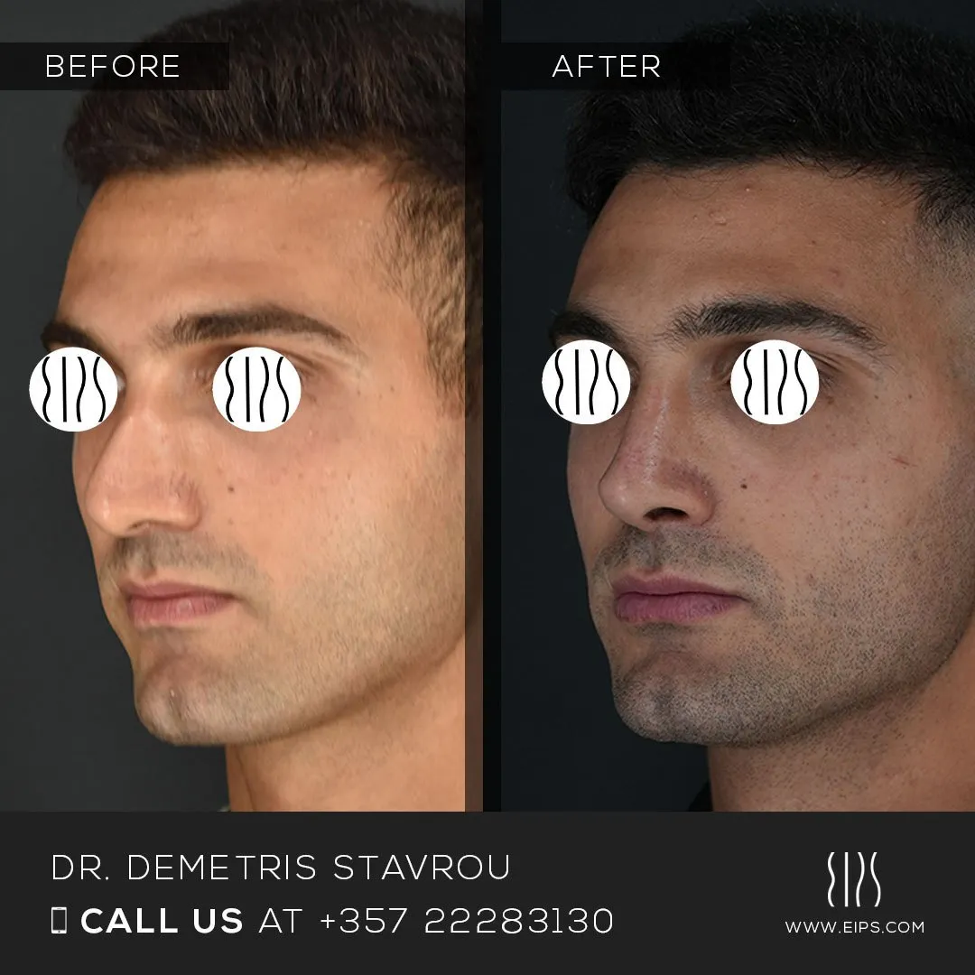 Rhinoplasty before and after