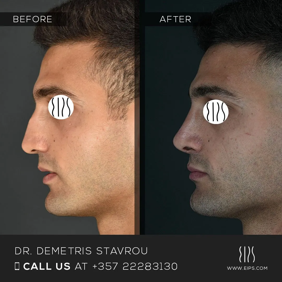 Rhinoplasty before and after
