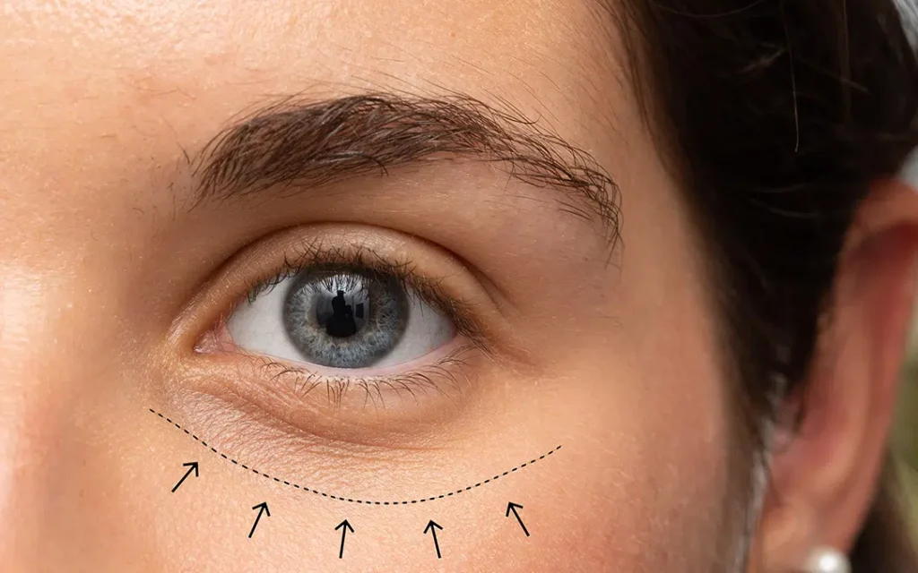 blepharoplasty procedure