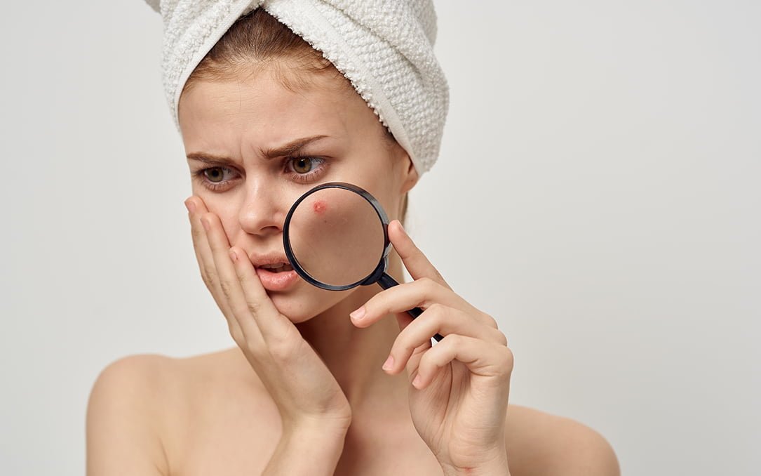 How Visible Are Acne Scars After a Facelift? EIPS